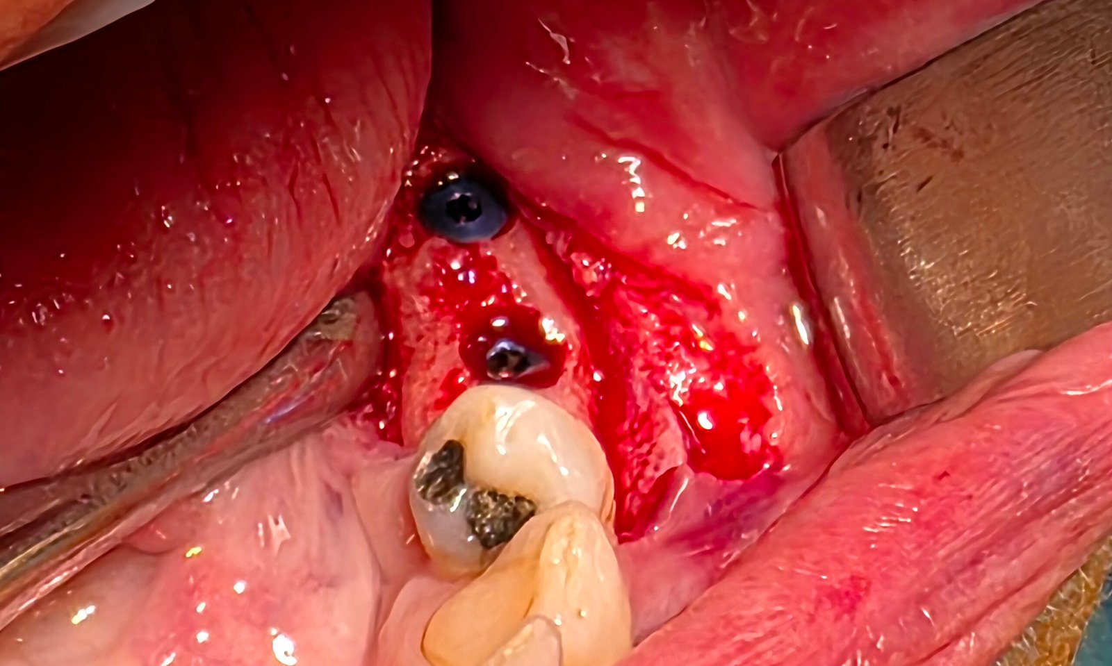 Level 1 — implant placements