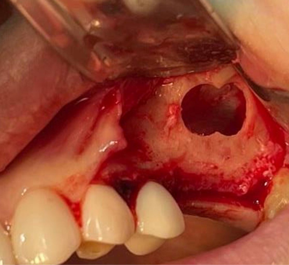 Level 2 — lateral sinus lift
